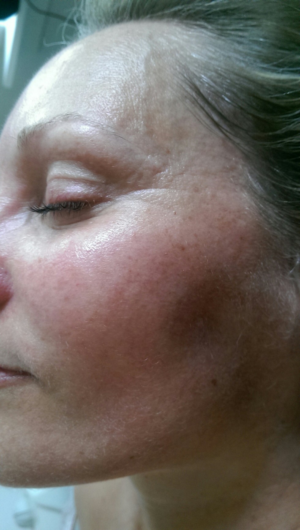 ansigtsbehandling-efter-1