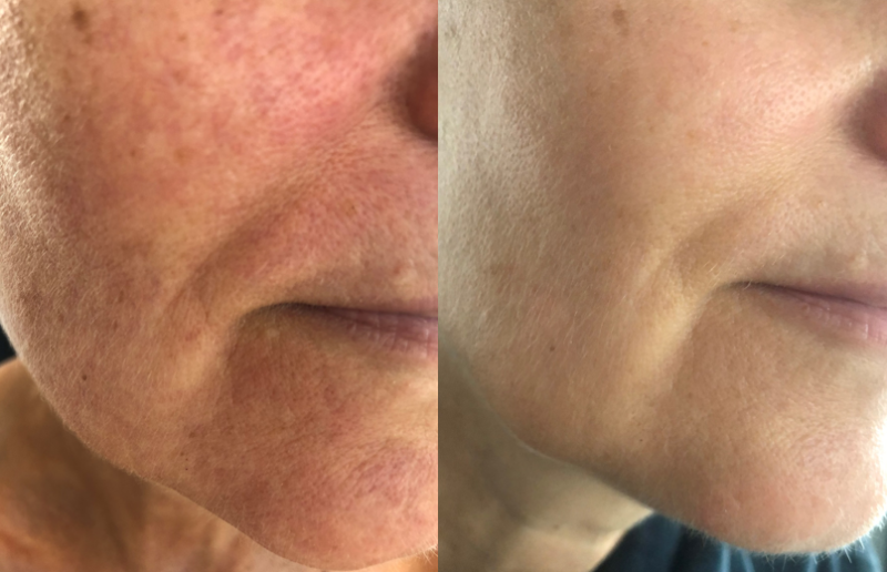 30-dages kur med pHformula